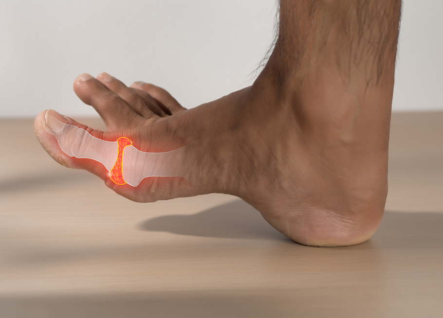 What is gout?