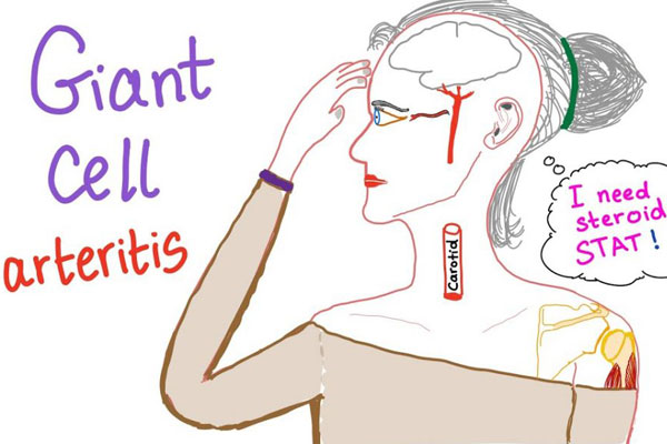 Symptoms of Giant Cell Arteritis