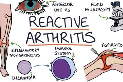 Reactive Arthritis: Uncomfortable But Usually Not Serious - Dr. Naveen ...