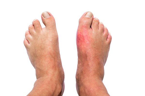 How Do You Get Rid of Gout Pain Fast  