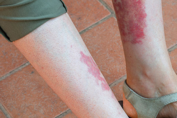 What is Vasculitis of the Legs?