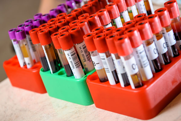 6 Blood Tests Used to Diagnose Rheumatoid Arthritis