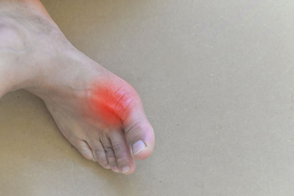 Hallux Limitus as a Cause of Big Toe Pain