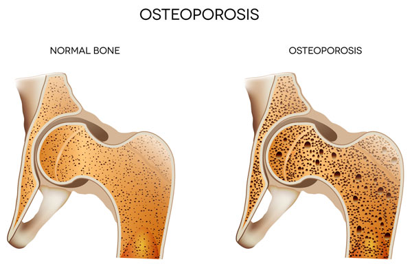 Common Treatments for Osteoporosis