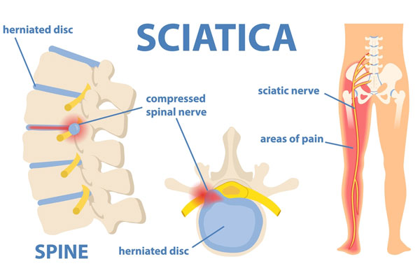 The Effects Of Physiotherapy On A Herniated Disc