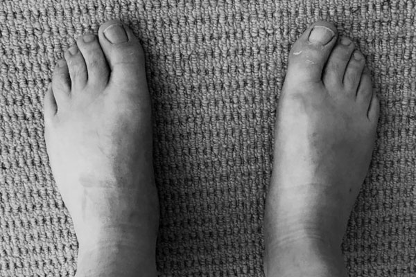 What is Gout and How To Manage It?