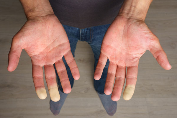 What you need to know about Raynaud’s Disease
