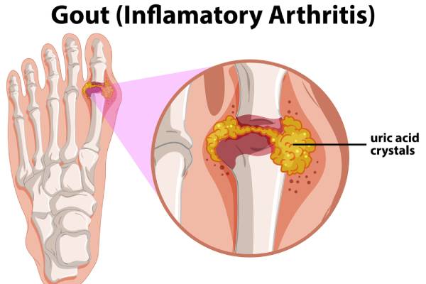 Can You Have Tophi With Gout?