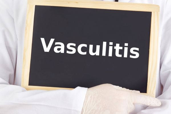 How Rare is Vasculitis (UK)