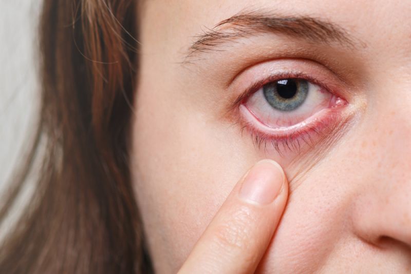 Can Psoriatic Arthritis Affect Your Eyes?